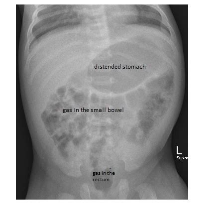 Imaging Case Of The Week 298 Answer Emergucate