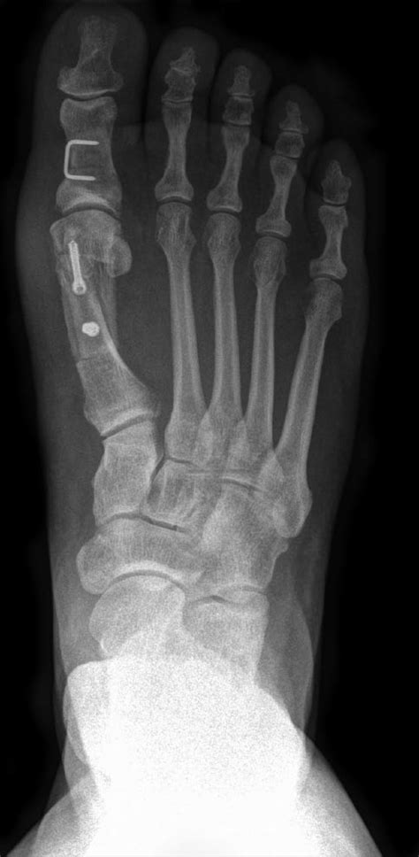 Scarf osteotomy with simultaneous Akin osteotomy. | Download Scientific Diagram