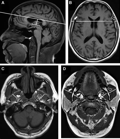 Magnetic Resonance Imaging Evaluation Of Masticatory Muscle Medicine