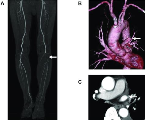 Computed Tomography Ct Images Obtained At The Onset Of Acute Limb Download Scientific Diagram