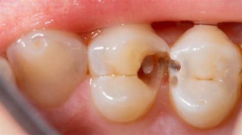 Black Lines On Teeth Causes Treatment Options In Bassendean