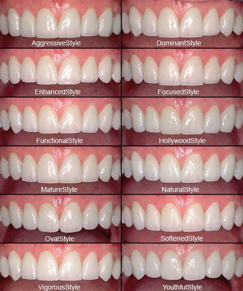 Porcelain Veneers Cosmetic Dentist Los Angeles Beverly Hill Dentist