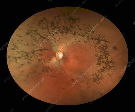 bone spicules stock image  science photo library