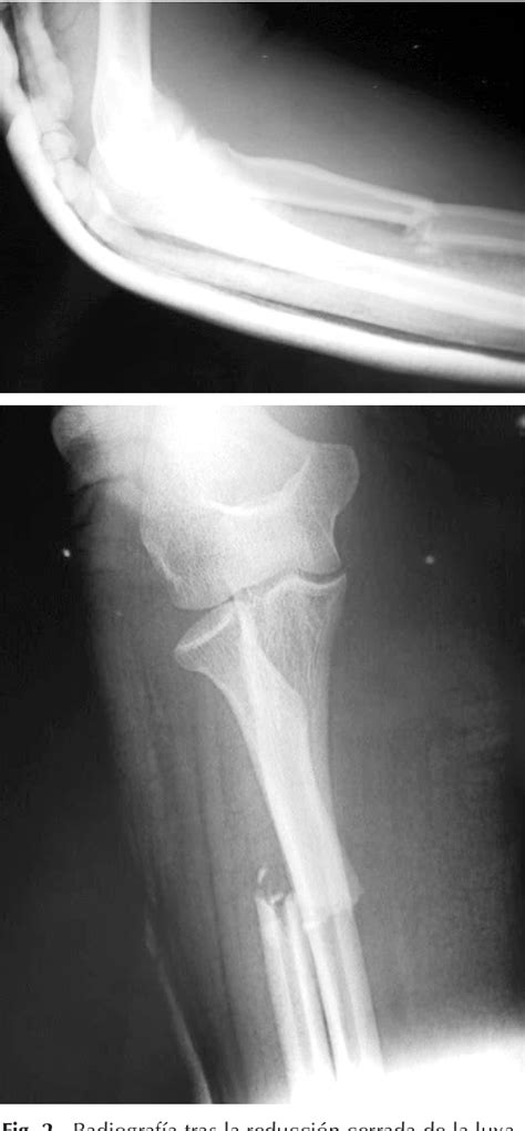 Figure From Luxaci N De Codo Asociada A Fractura Diafisaria De Radio