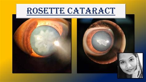 Everything You Want To Know About Rosette Cataract Ophthalmology