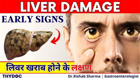 Liver Kharab Hone Ke Lakshan Liver Cirrhosis Early Signs Liver Damage Signs And Symptoms