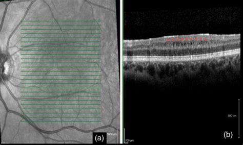 Retinal Inflammation In Multiple Sclerosis Revealed By Optical Coherence Tomography And