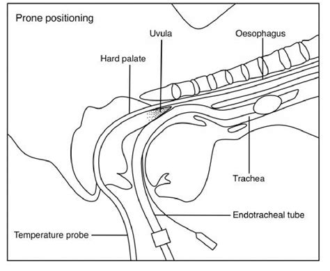 Figure 1 From Uvular Necrosis In An Adolescent Following General