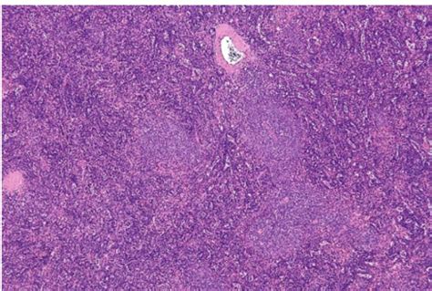 Lymphoid Neoplasia II Flashcards | Quizlet