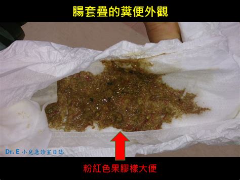 孩子腸套疊怎麼看內有排泄物照說明 嬰兒與母親