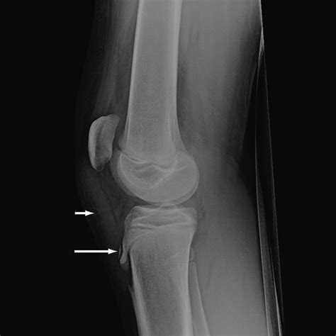 Osgood Schlatter Disease Symptoms