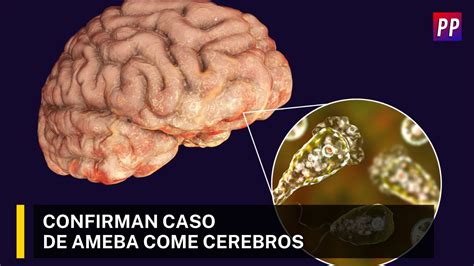 Confirman Caso De Ameba Come Cerebros YouTube