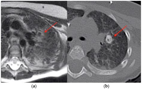 Transplantology Free Full Text Calcified Granulomatous Pneumocystis Jirovecii Pneumonia In A