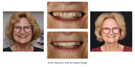 Joyful Smiles Before And After Makeovers Dr Joy Brauer