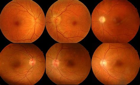 First row: Color fundus photography of NAION patient without carotid ...