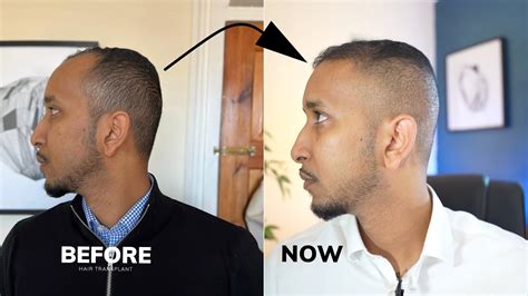 Peak Performance Week Fue Hair Transplant Results From Asli