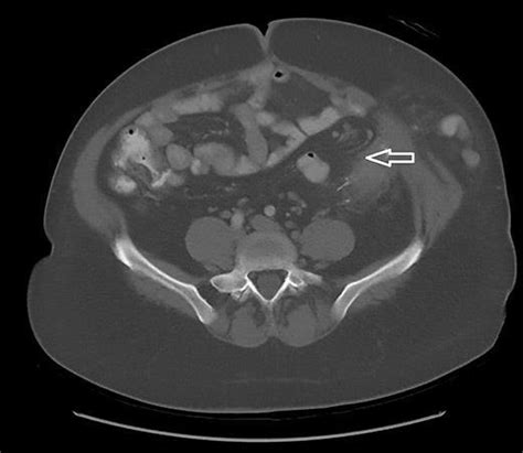 CT scan (abdomen) (8 weeks after treatment) showing near complete... | Download Scientific Diagram