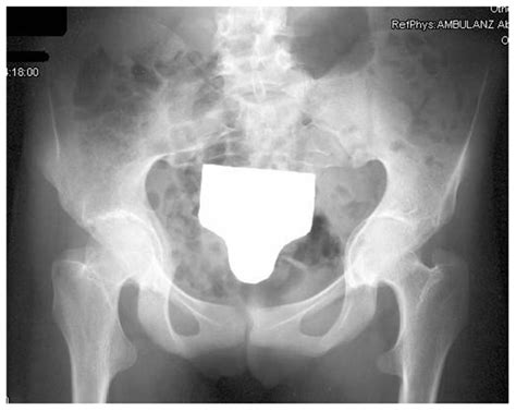 Ap Radiograph Of The Hips In A Year Old Patient With Marfan Syndrome