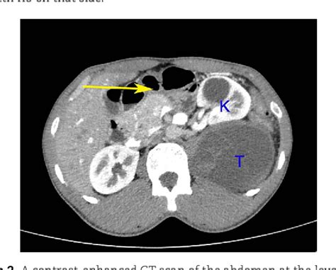 Figure From Paravertebral Retroperitoneal Ancient Schwannoma