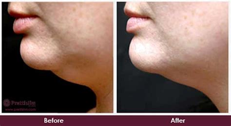 U Lipo® Face Chin Tuck Prettislim Clinic