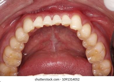 Larynx Throat Glands Tongue Viral Lingitis 스톡 사진 1446528692 Shutterstock