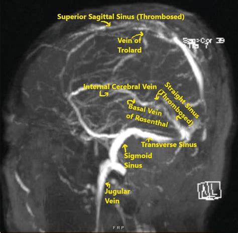 Cerebral Venous Thrombosis A Clinical Overview Intechopen