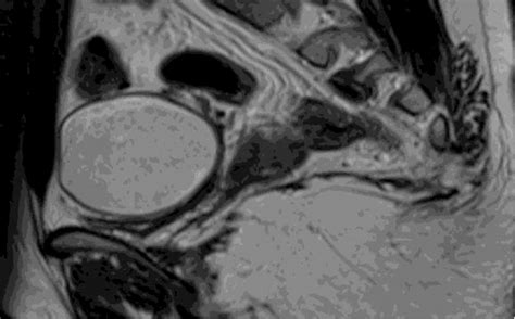 Ultrasound of right adnexal mass. | Download Scientific Diagram