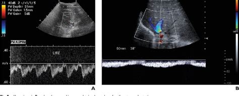 Figure 5 From Doppler Ultrasound Velocities And Resistive Indexes