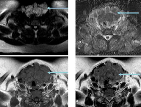 A D Mri Images A Axial Dwi B Axial Adc Map C Axial T Wi D