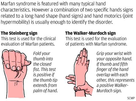 Marfan Syndrome Hand Test