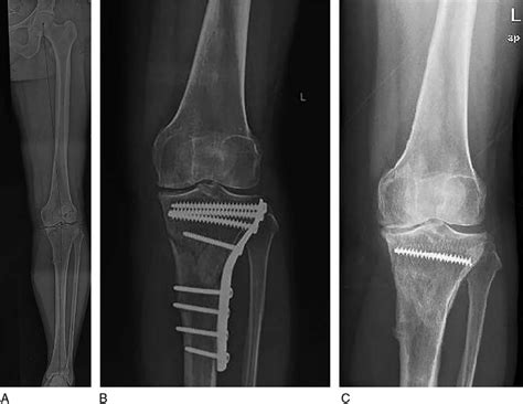 The Preoperative X Ray Films Of The Left Knee A The X Ray Of The