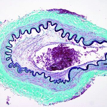 Trichrome Stained Section Of The Right Middle Cerebral Artery Showing