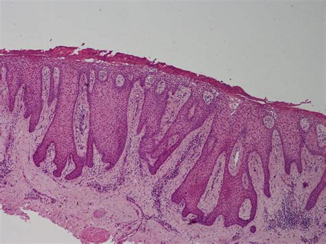 Acanthoma; Acanthoma, Clear Cell