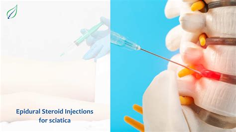 Epidural Steroid Injections Relief For Sciatica Pain Best Back Pain