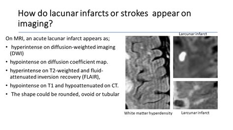 How Do Lacunar Infarcts Or Strokes Appear On Imaging World Stroke