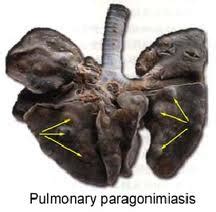 Enfermedades Tropicales Trematodiasis Alimentarias Paragonimiasis