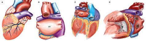 Anatomy Of Left Atrial Appendage