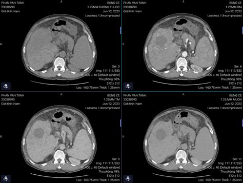 Cirrhotic Liver Nodules Can Be Classified Into Three Types Regenerative Liver Nodules