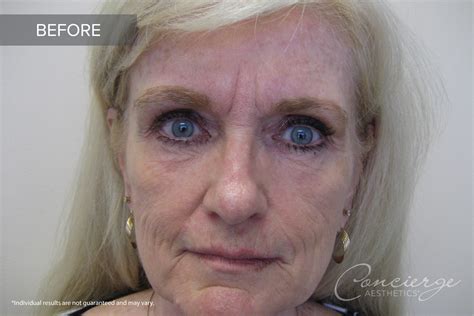 Before And After Juvederm Ultra And Botox 69 Yo Concierge Aesthetics