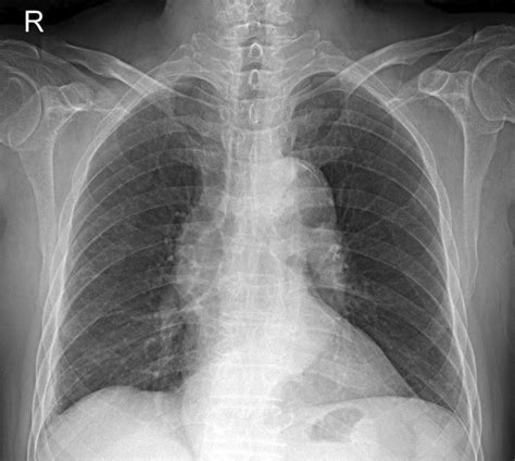 Chest Posteroanterior View Shows Mass On The Left Hilum And Infrahilar Download Scientific