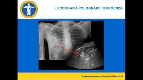 Ecografia Polmonare In Urgenza YouTube