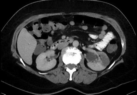 Ct Of Abdomen And Pelvis Showing An Aterior Inferior Renal Wedge Download Scientific Diagram