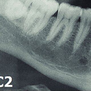 Panoramic Radiographs Illustrating The Mandibular Cortical Index C