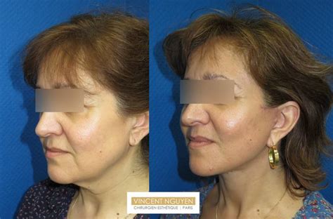 Lifting Cervico Facial Ou Du Bas Du Visage Dr Nguyen Paris