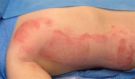 Mixed Superficial Partial Thickness And Mid Partial Thickness Burn