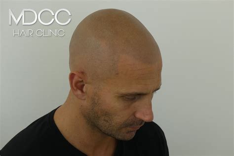 Greffe Et Implant Cheveux Marseille Micropigmentation Cheveux