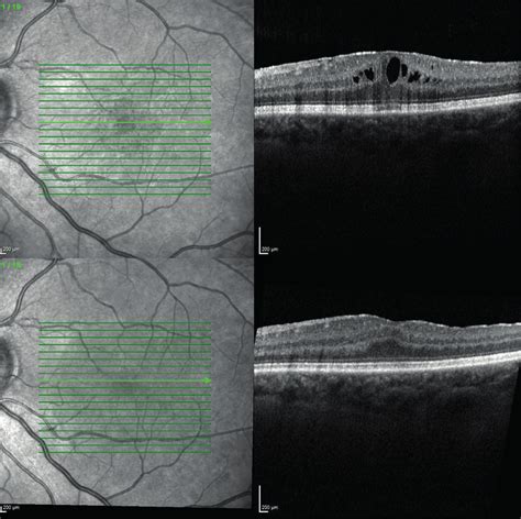 OCT B scan of the patient with an epiretinal membrane and cystic... | Download Scientific Diagram