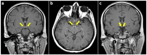 Behavioral Sciences Free Full Text Isolated Mammillary Bodies