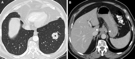 A 55 Year Old Female Patient Presented With Intermittent Hemoptysis