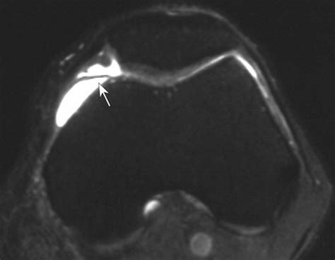 Anatomy And Mr Imaging Appearances Of Synovial Plicae Of The Knee